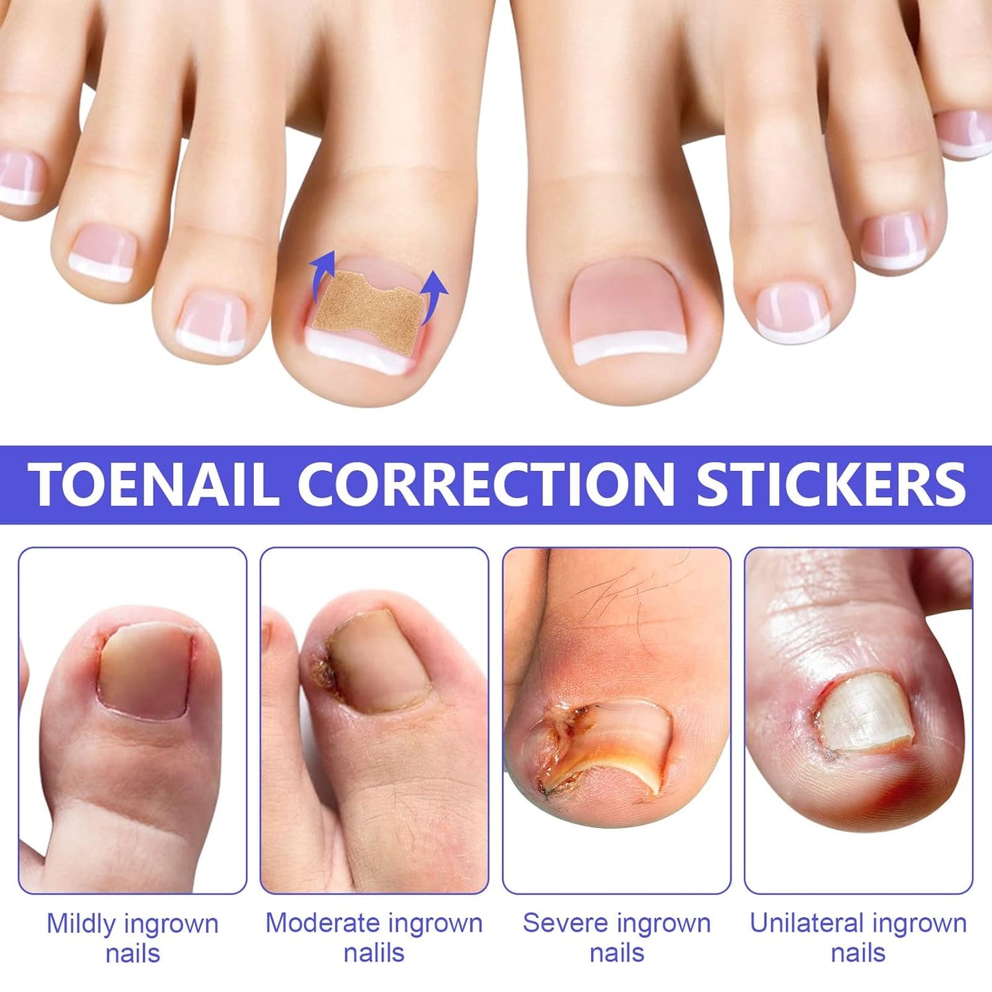 Ingrown Toenail Corrector Patches, 100Pcs