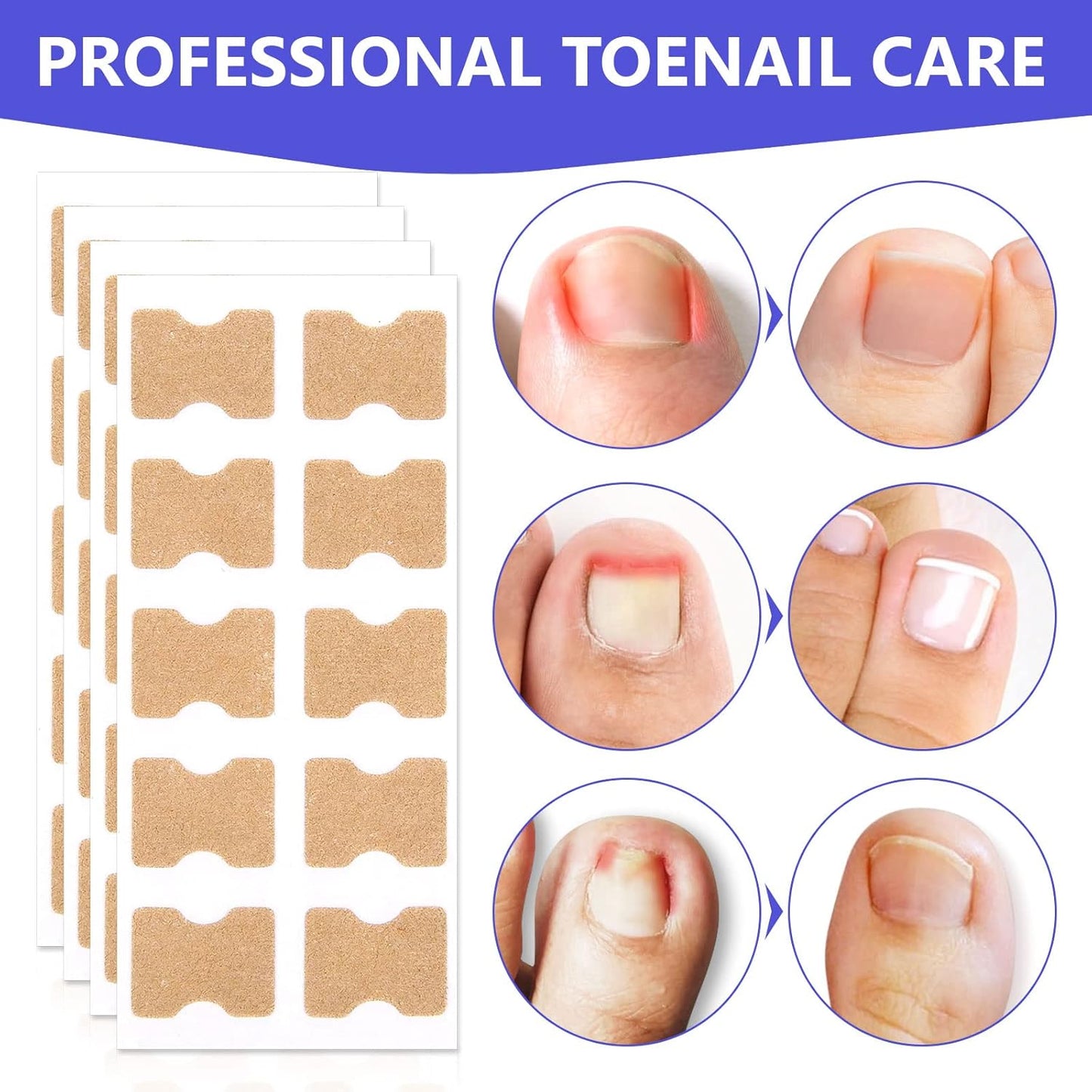 Ingrown Toenail Corrector Patches, 100Pcs