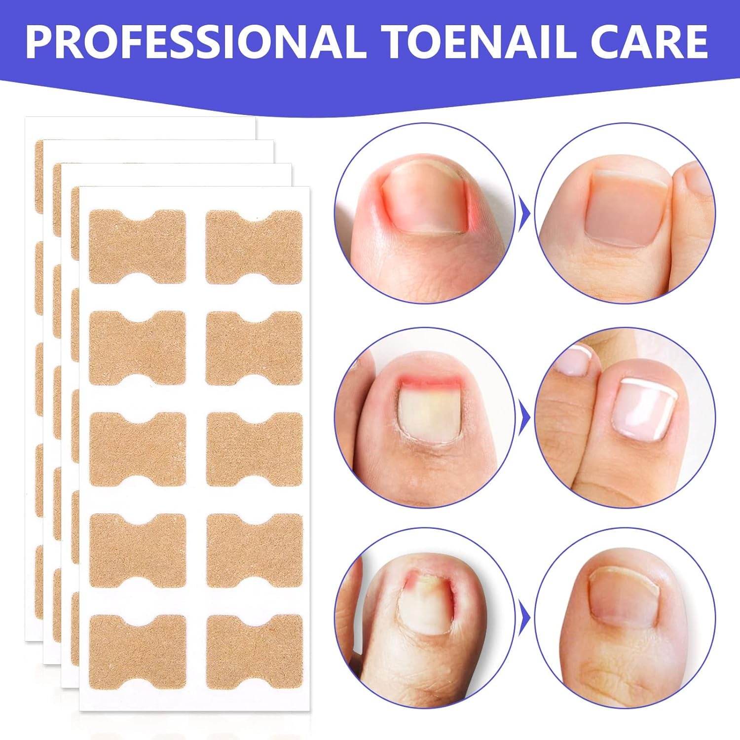 Ingrown Toenail Corrector Patches, 100Pcs