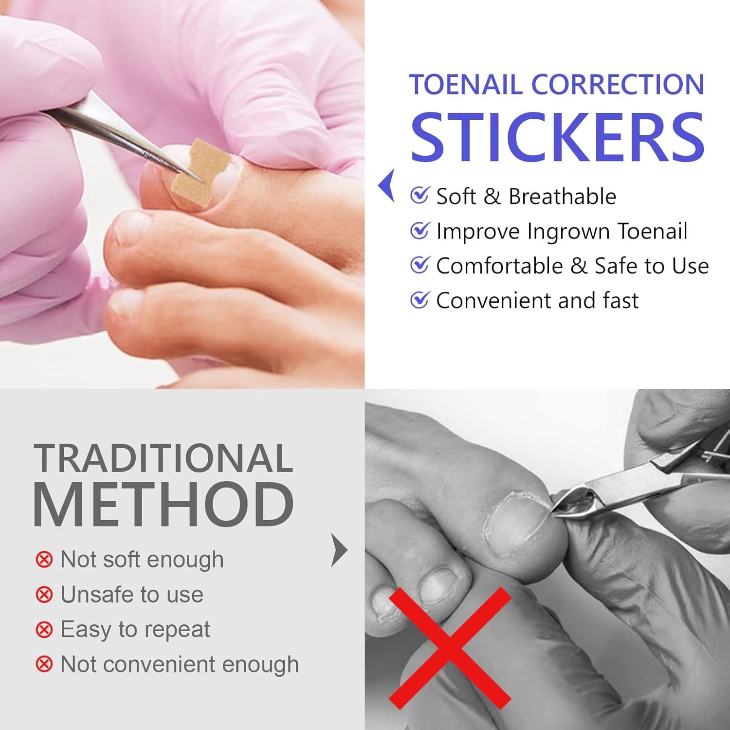 Ingrown Toenail Corrector Patches, 100Pcs