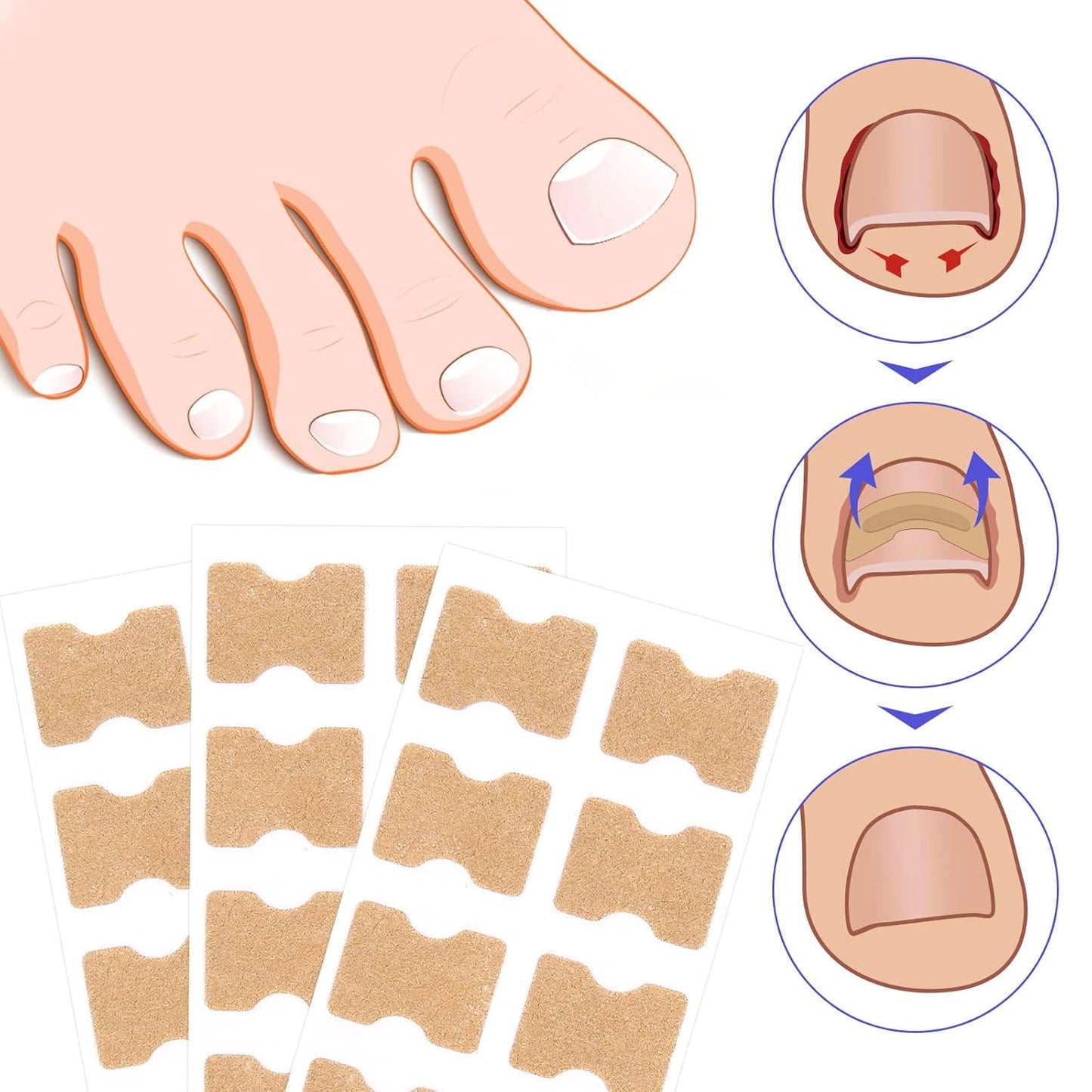 Ingrown Toenail Corrector Patches, 100Pcs